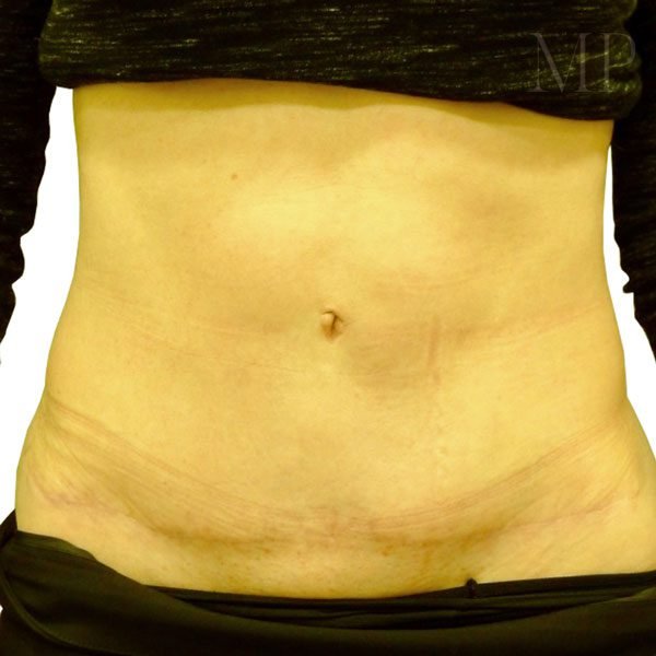 Abdominoplasty-3-Post-Op