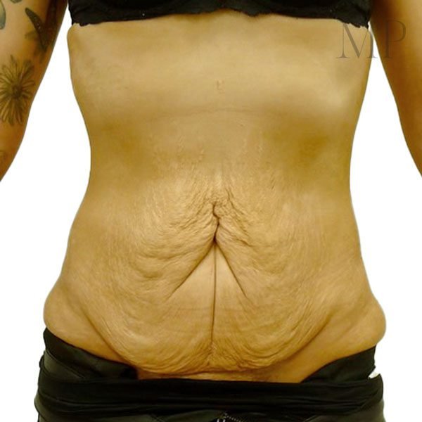 Abdominoplasty-4-Pre-Op