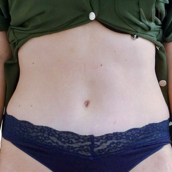 Abdominoplasty-Patient-03-After