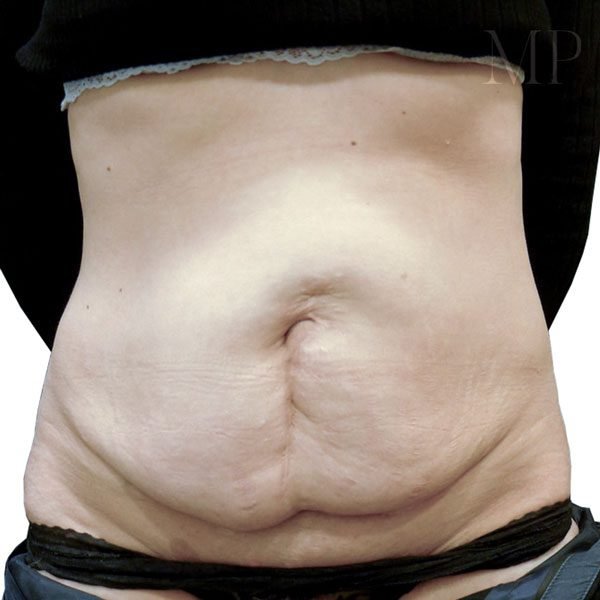 Abdominoplasty-Patient-03-Before