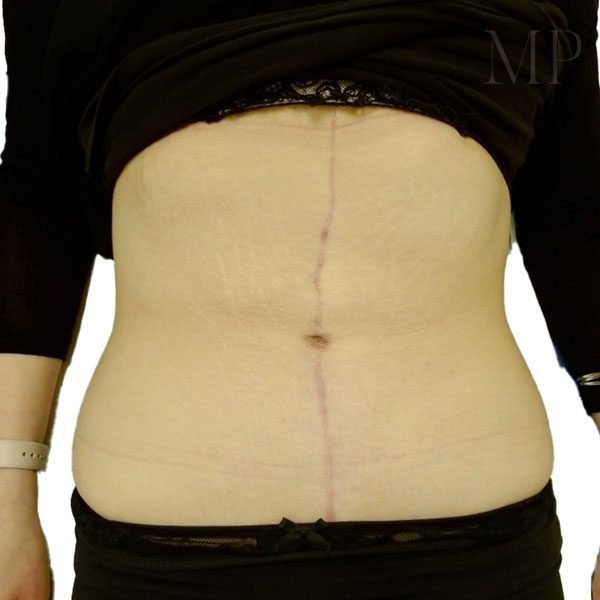 Abdominoplsty-2-Post-Op