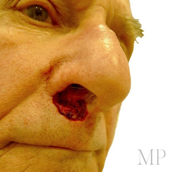 Before-Reconstruction-Following-BCC-MOHS-Excision