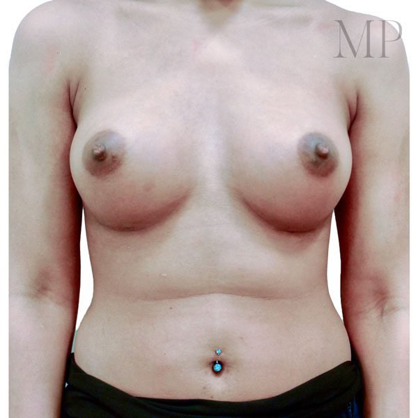 Breast-Aug-1-Post-Op