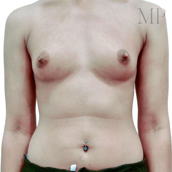 Breast-Aug-1-Pre-Op