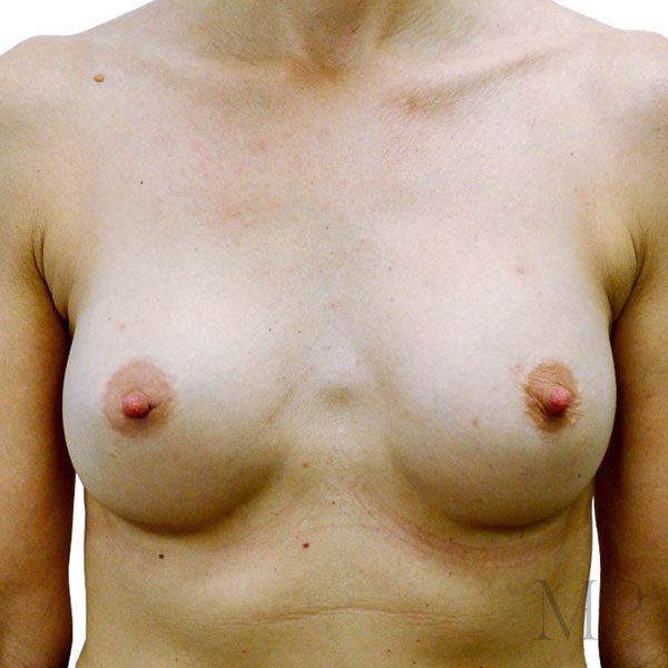 Breast-Aug-2-Post-Op