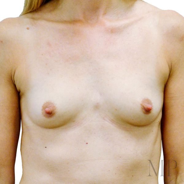 Breast-Aug-2-Pre-Op