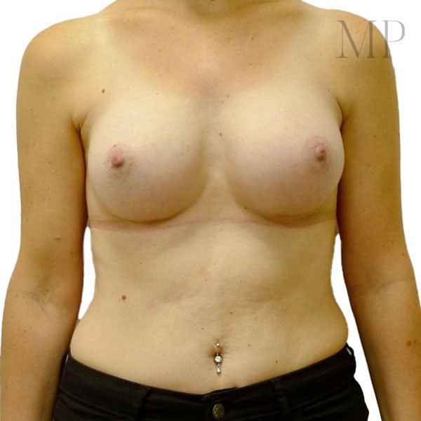 Breast-Aug-3-Post-Op