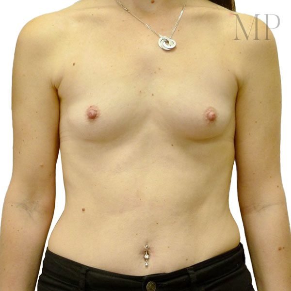 Breast-Aug-3-Pre-Op