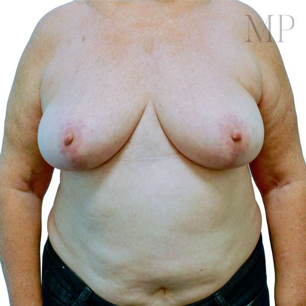 Breast-Reduction-2-Post-Op