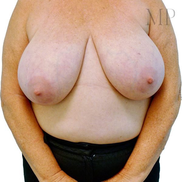 Breast-Reduction-2-Pre-Op