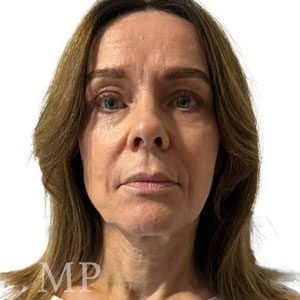 CM-pre-op-High-SMAS-deep-plane-face-lift-pre-op-