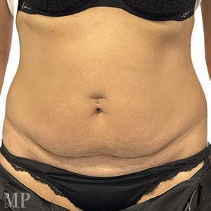 CR-pre-op-anterior-hall-marked-