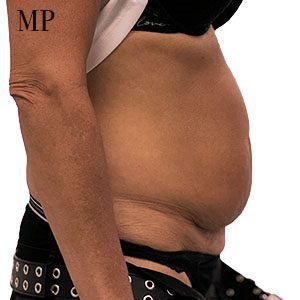 CR-pre-op-right-lateral-Hall-marked-