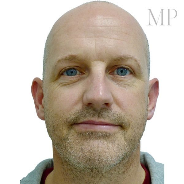 Direct-Brow-Lift-After-Male
