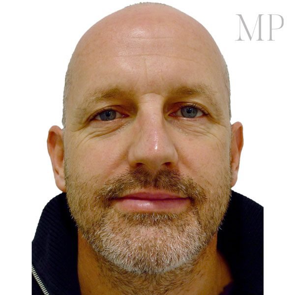 Direct-Brow-Lift-Before-Male