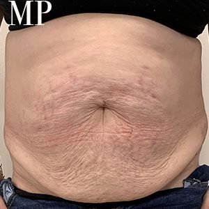 EM-pre-op-abdominoplasty.-jpg