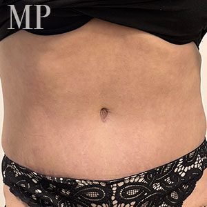 Em-post-op-frontal-abdominoplasty-1-1