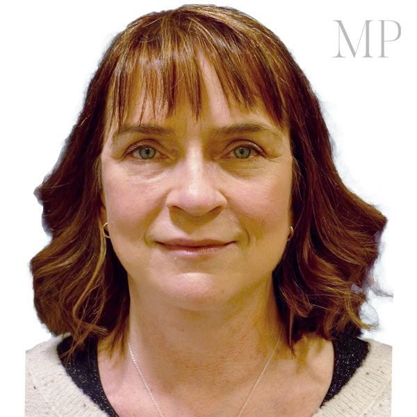 Face-Lift-5-From-Front-After