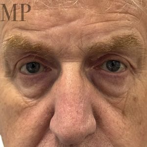 GH-post-op-close-up-upper-bleph-