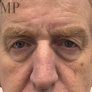 GH-pre-op-close-up-upper-blepharoplasty-