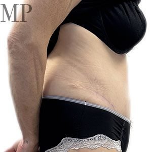JC-abdominoplasty-lateral-post-op-