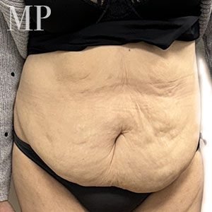 JC-abdominoplasty-pre-op-copy