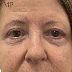 JM-post-op-PS-hall-marked