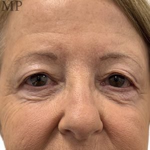 JM-pre-op-PS-hall-marked