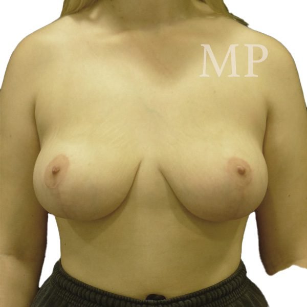 KD-mastopexy-post-op-at-6-months_