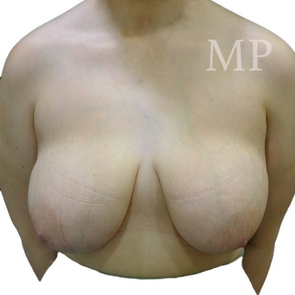 KD-mastopexy-pre-op_