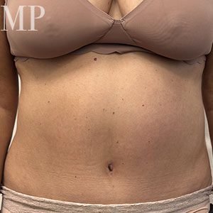 LA-post-op-abdominoplsty