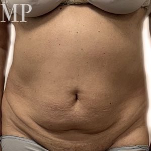 LA-pre-op-abdominoplasty-