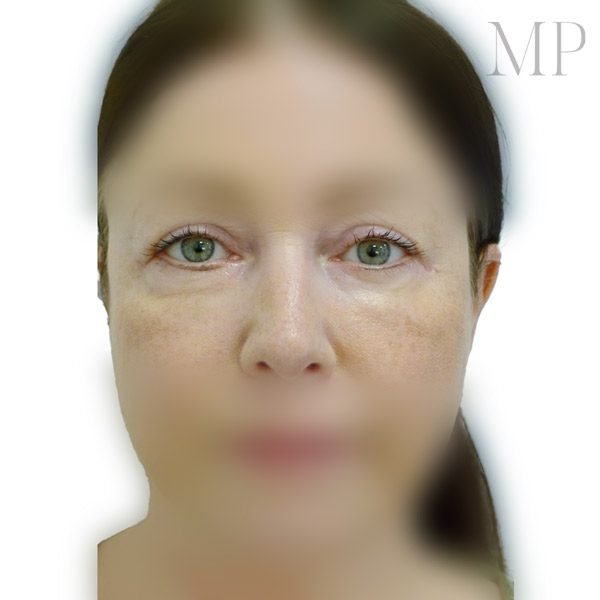 Lower-Blepharoplasty-1-After