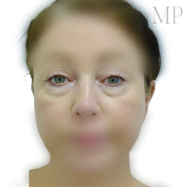 Lower-Blepharoplasty-1-Before