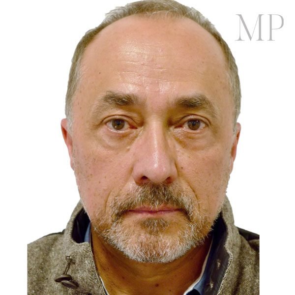 Male-Lower-Blepharoplasty-Post-Op