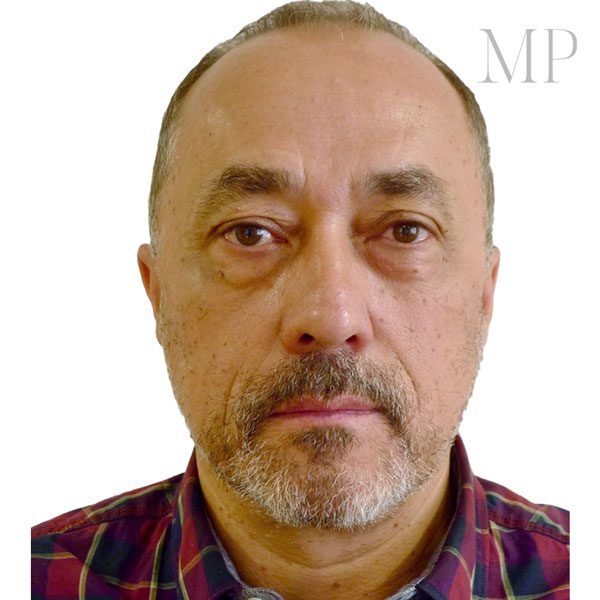 Male-Lower-Blepharoplasty-Pre-Op