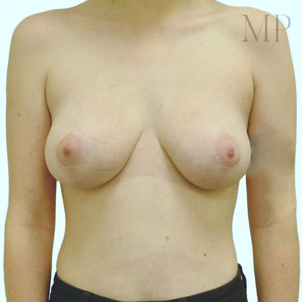 Mastopexy-1-Post-Op