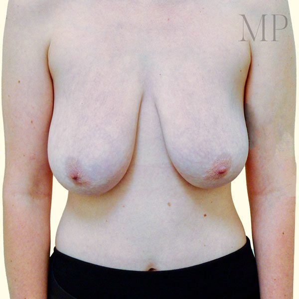 Mastopexy-1-Pre-Op