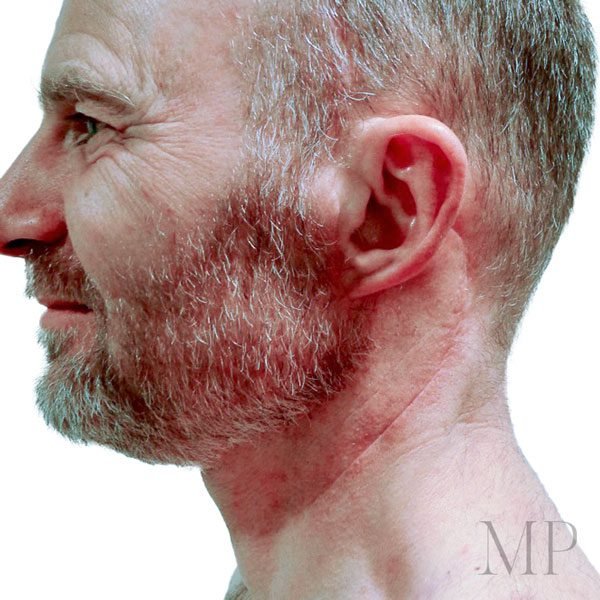 Neck-Dissection-3-After-Neck-Dissection