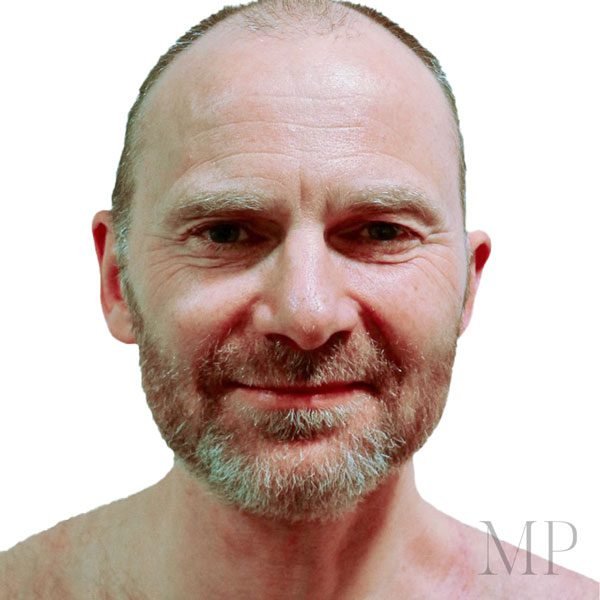 Overview-photo-and-title-for-photo-for-hte-after-and-after-22three-months-after-neck-and-parotid-resection-with-symetrical-smile