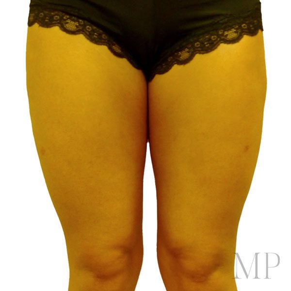 Post-Op-Liposuction