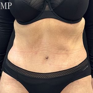 SA-post-op-hall-marked-