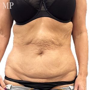 SA-pre-op-anterior-hall-marked-