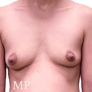 SA-pre-op-breast-augmentation-copy