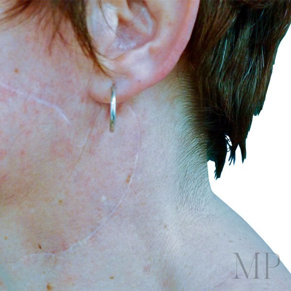 Superficial-Parotidectomy-Neck-Dissection-Scars-01