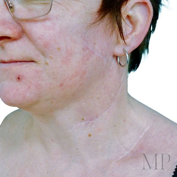 Superficial-Parotidectomy-Neck-Dissection-Scars-02