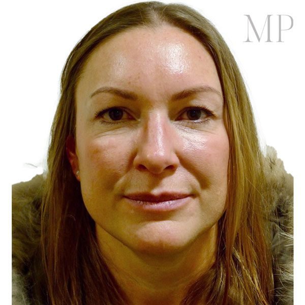 Upper-Blepharoplsaty-Patient-1-Before