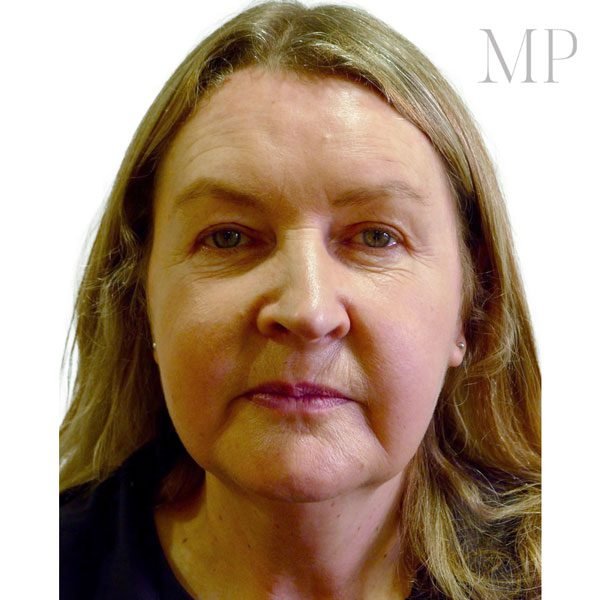 Upper-Blepharoplsaty-Patient-2-After
