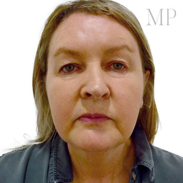 Upper-Blepharoplsaty-Patient-2-Before
