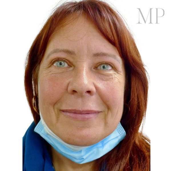Upper-Blepharoplsaty-Patient-4-After
